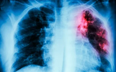 Tuberculosis en aumento: especialistas piden información, prevención y control