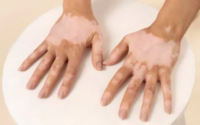 El vitiligo: una enfermedad de la piel que puede estar asociada a otras patologías