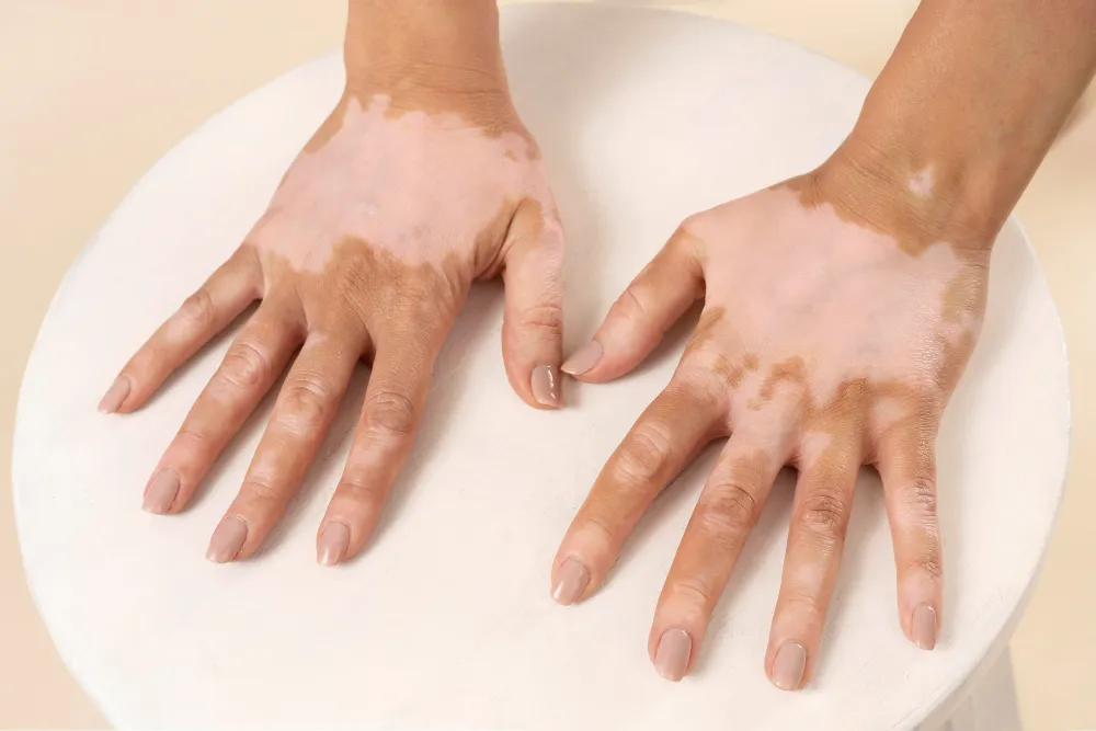 dermatologia-vitiligo